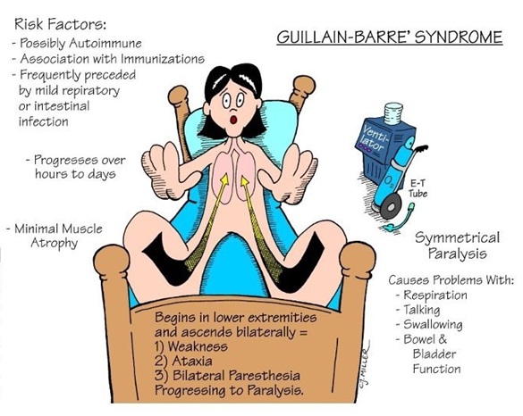 Hasil gambar untuk guillain-barre syndrome