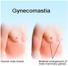 Gynecomastia