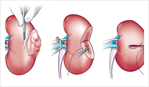 Kidney Cyst Size Chart