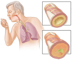 Chronic Obstructive Pulmonary Disease