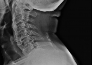 Diffuse Idiopathic Skeletal Hyperostosis