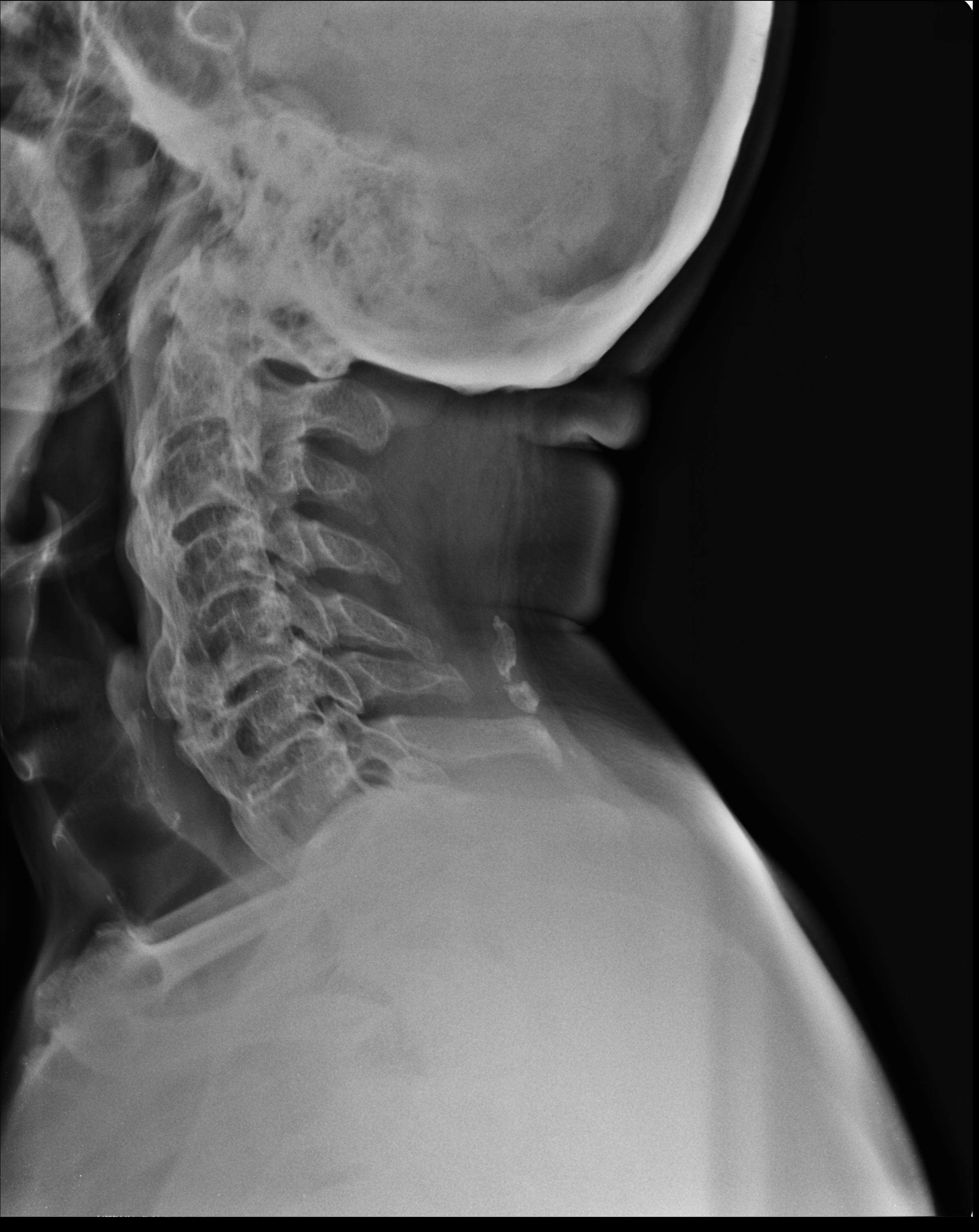 Diffuse Idiopathic Skeletal Hyperostosis