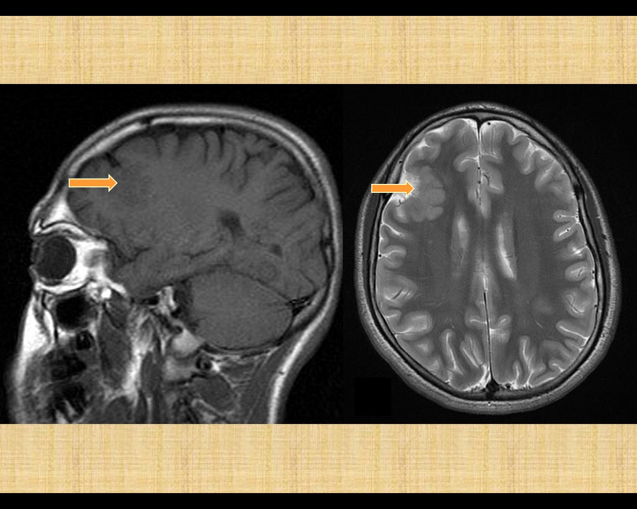 Frontal Lobe Epilepsy