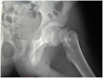 Hip Fracture