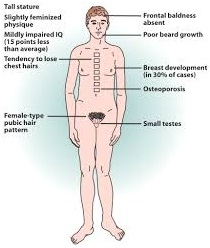 Klinefelter Syndrome