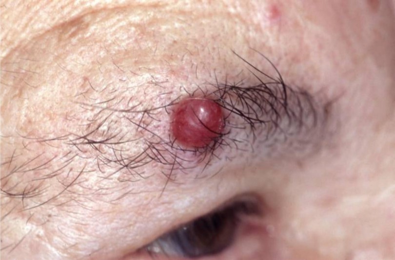 Lymph Cancer Natural Treatment Lymph Cancer Natural Treatment