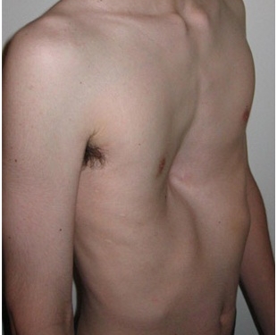 Pectus Excavatum