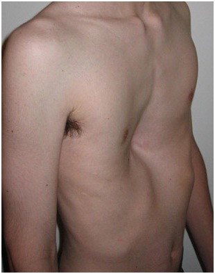 Pectus Excavatum