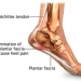 Plantar Fasciitis