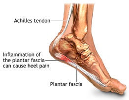 Plantar Fasciitis