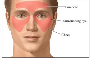 Stickler Syndrome Natural Treatment Stickler Syndrome Natural Treatment