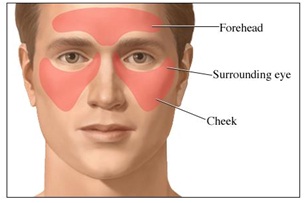 Sinus Headache