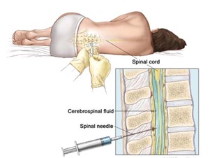 Spinal Headache