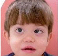 Stickler Syndrome Natural Treatment Stickler Syndrome Natural Treatment