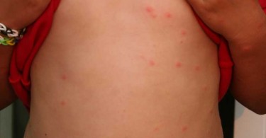 heat rash vs swimmers itch heat rash vs swimmers itch