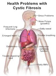 cystic-fibrosis