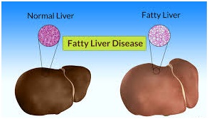 Fatty Liver Disease