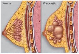 Fibrocystic Breast