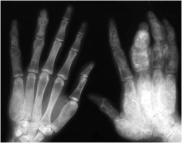 Fibrous Dysplasia