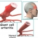 Giant Cell Arteritis
