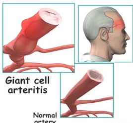 Giant Cell Arteritis