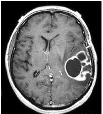 Glioma