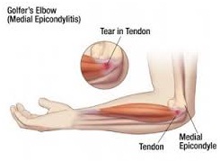 Golfer Elbow