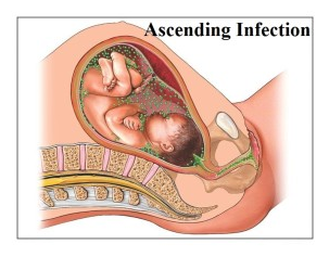 Group B Streptococcus