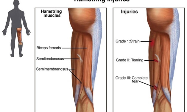 Hamstring Injury