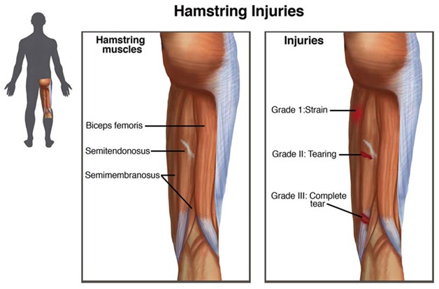 Hamstring Injury