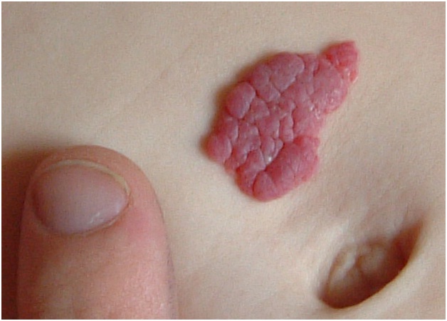 Hemangioma