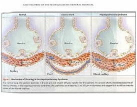 Hepatopulmonary Syndrome