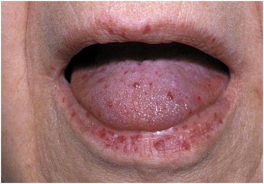 Hereditary Hemorrhagic Telangiectasia