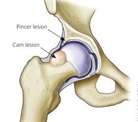 Hip Impingement Syndrome
