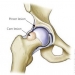 Hip Impingement Syndrome