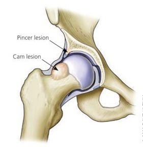 Hip Impingement Syndrome