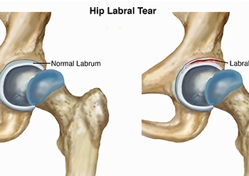 hip-labral-tear