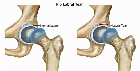 hip-labral-tear