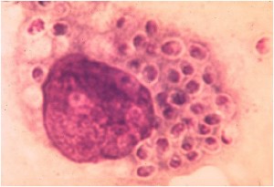 Histoplasmosis Symptoms, Causes, Diagnosis and Treatment - Natural