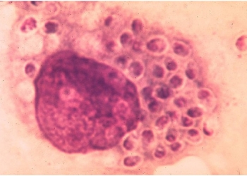 histoplasmosis