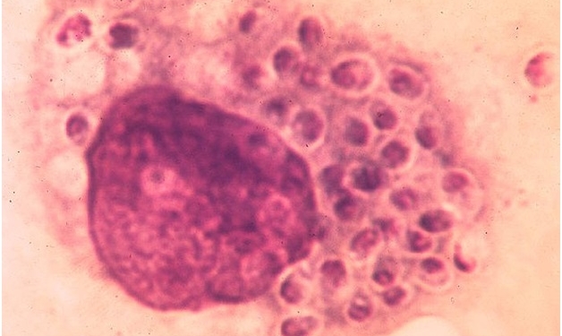 histoplasmosis