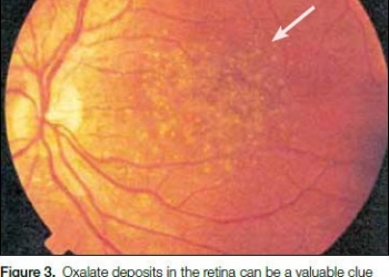 hyperoxaluria-and-oxalosis