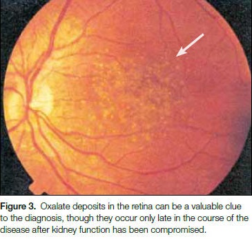 hyperoxaluria-and-oxalosis