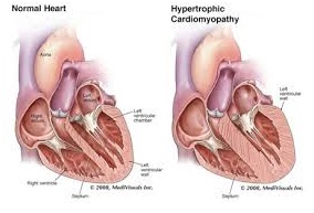 hypertrophic-cardiomyopathy