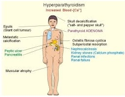 hypoparathyroidism