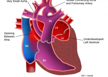 hypoplastic-left-heart-syndrome