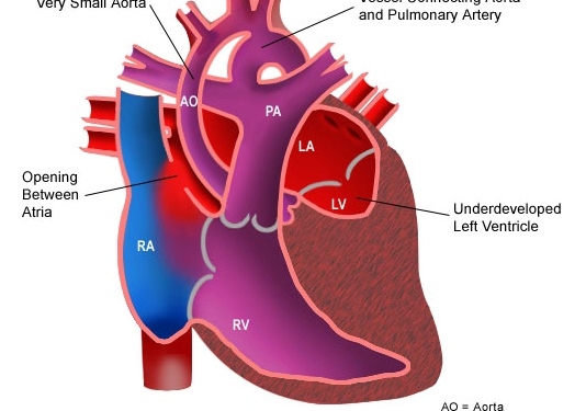 hypoplastic-left-heart-syndrome