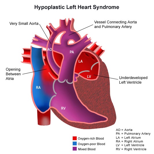 hypoplastic-left-heart-syndrome