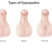 hypospadias
