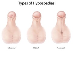 hypospadias